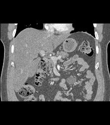 Mesenteric Cyst - CTisus CT Scan