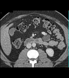 Mesenteric Cyst - CTisus CT Scan