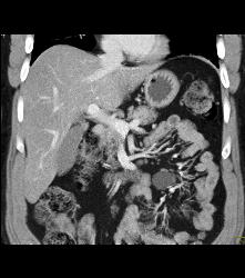 Mesenteric Cyst - CTisus CT Scan