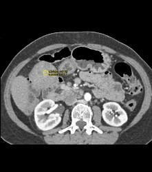 Desmoid Tumor - CTisus CT Scan