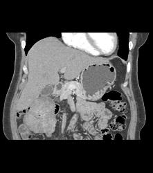 Desmoid Tumor - CTisus CT Scan