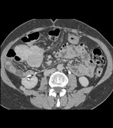 Desmoid Tumor - CTisus CT Scan