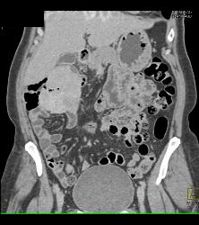 Desmoid Tumor - CTisus CT Scan