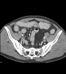 Crohn's Disease - CTisus CT Scan