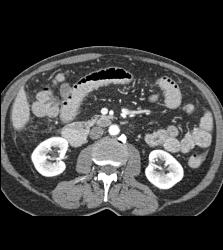 Crohn's Disease - CTisus CT Scan