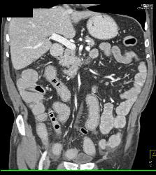 Crohn's Disease - CTisus CT Scan