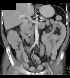 Crohn's Disease - CTisus CT Scan