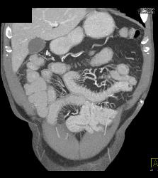 Crohn's Disease - CTisus CT Scan