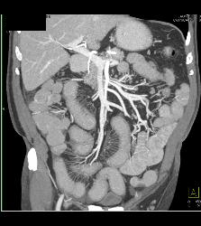 Crohn's Disease - CTisus CT Scan