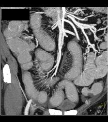 Crohn's Disease - CTisus CT Scan