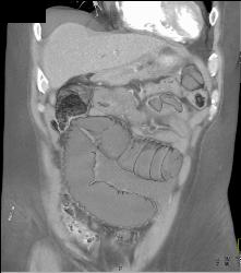 Small Bowel Obstruction (SBO) With Ischemic Bowel - CTisus CT Scan