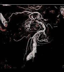 Small Bowel Obstruction (SBO) With Ischemic Bowel - CTisus CT Scan