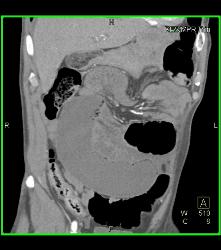 Small Bowel Obstruction (SBO) With Ischemic Bowel - CTisus CT Scan