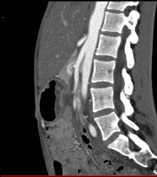 Superior Mesenteric Artery (SMA) Syndrome - CTisus CT Scan