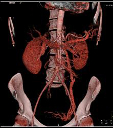 Superior Mesenteric Artery (SMA) Syndrome - CTisus CT Scan