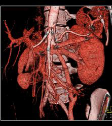 Superior Mesenteric Artery (SMA) Syndrome With Dilated Left Gonadal Vein - CTisus CT Scan