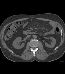 Mesenteric Panniculitis - CTisus CT Scan