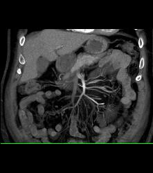 Mesenteric Panniculitis - CTisus CT Scan