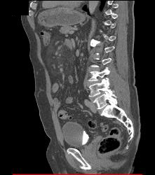 Mesenteric Panniculitis - CTisus CT Scan