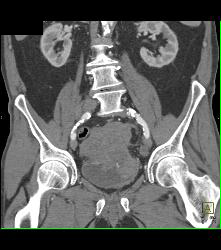 Small Bowel Carcinoma - CTisus CT Scan