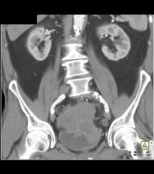 Small Bowel Carcinoma - CTisus CT Scan