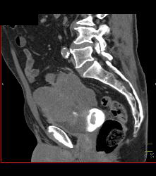 Small Bowel Carcinoma - CTisus CT Scan