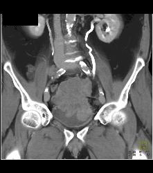 Small Bowel Carcinoma - CTisus CT Scan