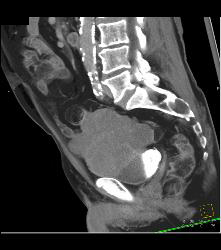 Small Bowel Carcinoma - CTisus CT Scan