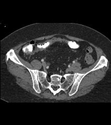 Ischemic Bowel Vs Crohn's Disease. Diagnosis- Crohn's Disease- See Full Sequence Including CT Small Bowel Series - CTisus CT Scan