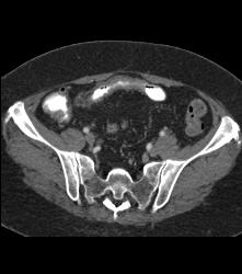 Ischemic Bowel Vs Crohn's Disease. Diagnosis- Crohn's Disease- See Full Sequence Including CT Small Bowel Series - CTisus CT Scan