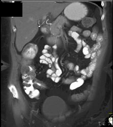 Ischemic Bowel Vs Crohn's Disease. Diagnosis- Crohn's Disease- See Full Sequence Including CT Small Bowel Series - CTisus CT Scan