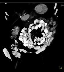 Ischemic Bowel Vs Crohn's Disease. Diagnosis- Crohn's Disease- See Full Sequence Including CT Small Bowel Series - CTisus CT Scan