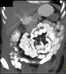 Ischemic Bowel Vs Crohn's Disease. Diagnosis- Crohn's Disease- See Full Sequence Including CT Small Bowel Series - CTisus CT Scan