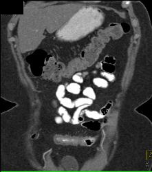 Ischemic Bowel Vs Crohn's Disease. Diagnosis- Crohn's Disease- See Full Sequence Including CT Small Bowel Series - CTisus CT Scan