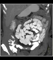 Ischemic Bowel Vs Crohn's Disease. Diagnosis- Crohn's Disease- See Full Sequence Including CT Small Bowel Series - CTisus CT Scan