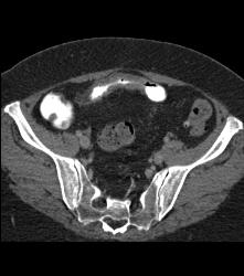 Ischemic Bowel Vs Crohn's Disease. Diagnosis- Crohn's Disease- See Full Sequence Including CT Small Bowel Series - CTisus CT Scan