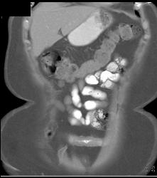 Ischemic Bowel Vs Crohn's Disease. Diagnosis- Crohn's Disease- See Full Sequence Including CT Small Bowel Series - CTisus CT Scan