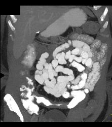 Ischemic Bowel Vs Crohn's Disease. Diagnosis- Crohn's Disease- See Full Sequence Including CT Small Bowel Series - CTisus CT Scan