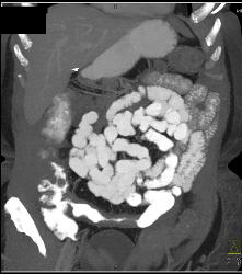 Ischemic Bowel Vs Crohn's Disease. Diagnosis- Crohn's Disease- See Full Sequence Including CT Small Bowel Series - CTisus CT Scan