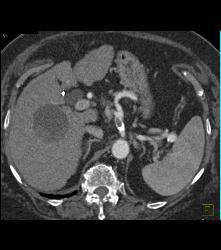 Clot in Celiac Artery - CTisus CT Scan