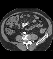 Sclerosing Mesenteritis Looks Like A Carcinoid Tumor - CTisus CT Scan