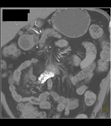 Sclerosing Mesenteritis Looks Like A Carcinoid Tumor - CTisus CT Scan