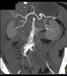 Sclerosing Mesenteritis Looks Like A Carcinoid Tumor - CTisus CT Scan