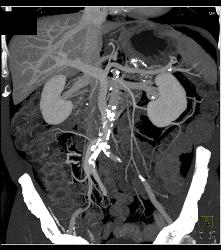 Sclerosing Mesenteritis Looks Like A Carcinoid Tumor - CTisus CT Scan