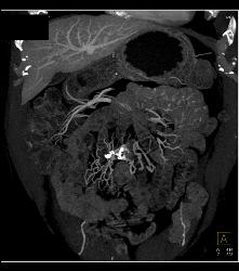 Sclerosing Mesenteritis Looks Like A Carcinoid Tumor - CTisus CT Scan