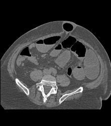 Normal Superior Mesenteric Artery (SMA) Angle- Patient Had Crohn's Disease - CTisus CT Scan