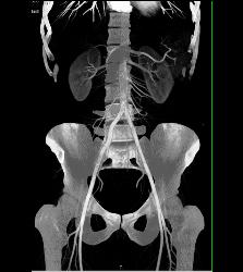 Normal Superior Mesenteric Artery (SMA) Angle- Patient Had Crohn's Disease - CTisus CT Scan