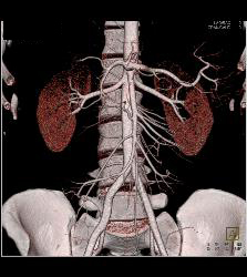 Normal Superior Mesenteric Artery (SMA) Angle- Patient Had Crohn's Disease - CTisus CT Scan