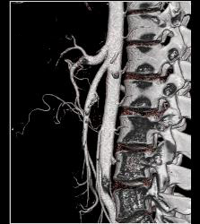 Normal Superior Mesenteric Artery (SMA) Angle- Patient Had Crohn's Disease - CTisus CT Scan