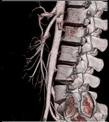 Normal Superior Mesenteric Artery (SMA) Angle- Patient Had Crohn's Disease - CTisus CT Scan